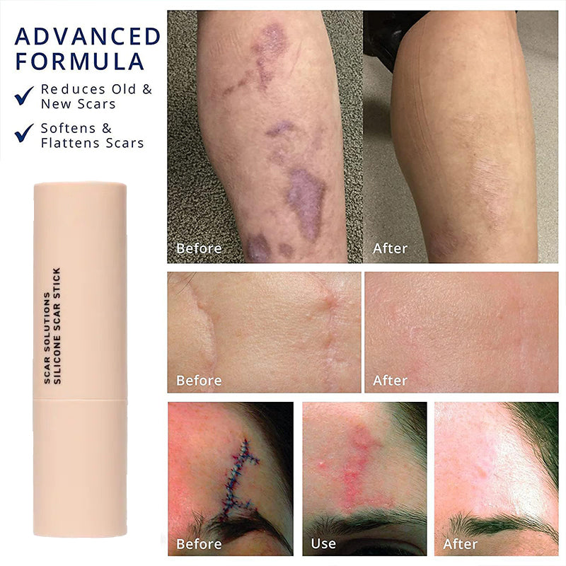 Gentle Silicone Scar Stick – Nourishing & Smoothing Balm for Facial Skin